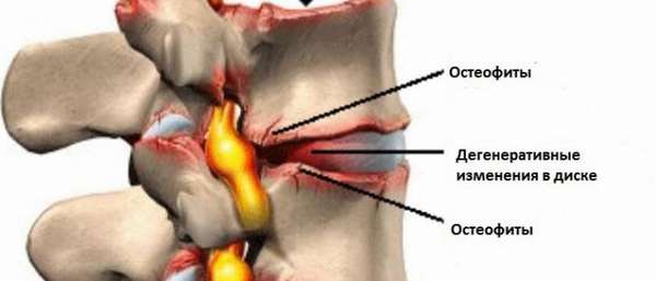 Что такое остеофиты и как их лечить?